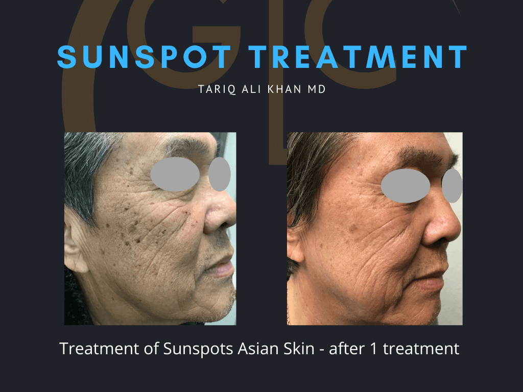 Gentle Care Laser Tustin Before and After picture - Sunspot treatment